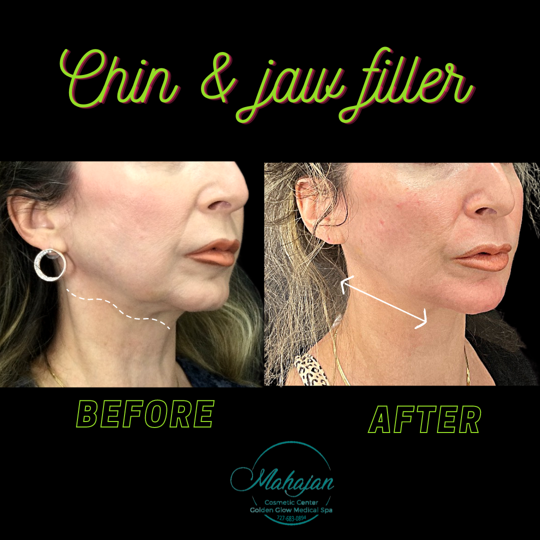 3 ml Juvederm Voluma to chin & Jaw