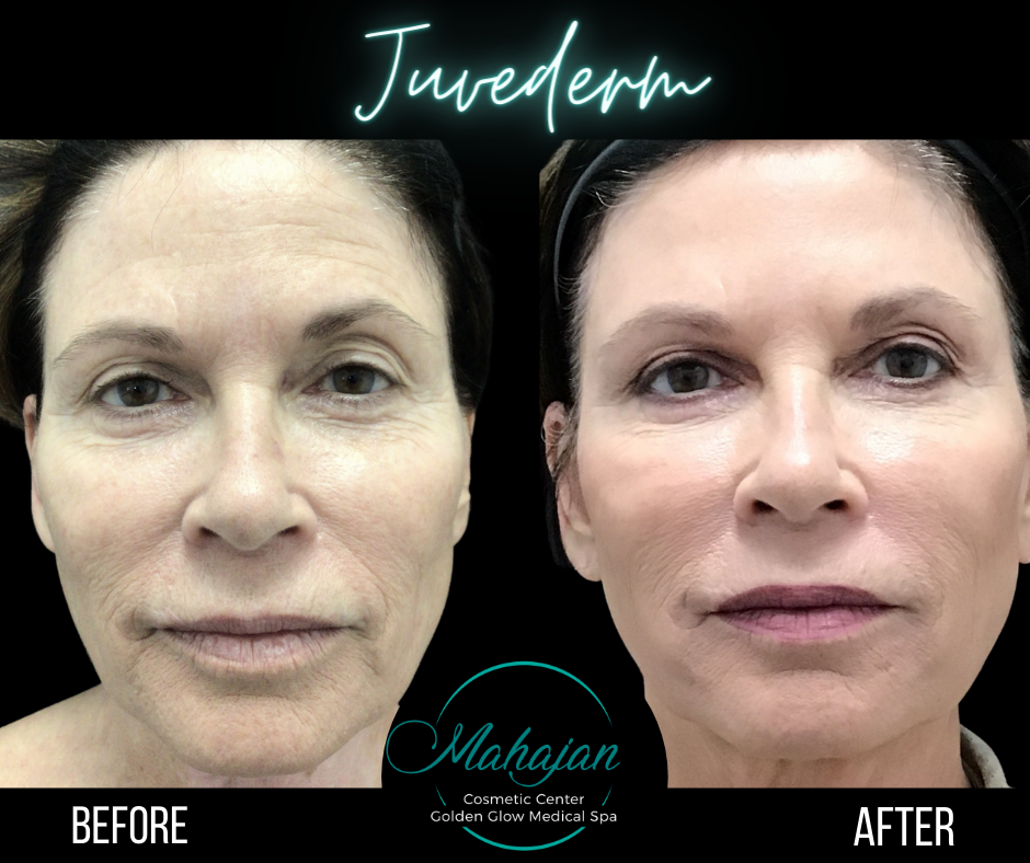 Dermal Fillers(1).png