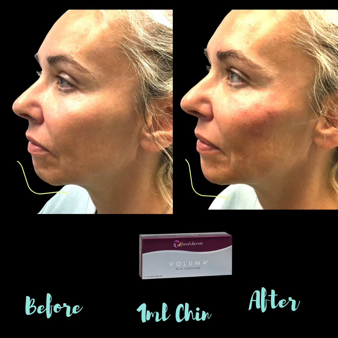 1ml Voluma in chin