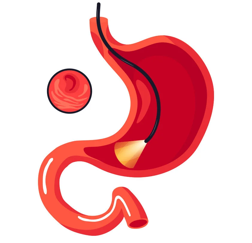 Upper GI Endoscopy (Gastroscopy) — Dr Marjan (Jane) Ghadiri · Brisbane