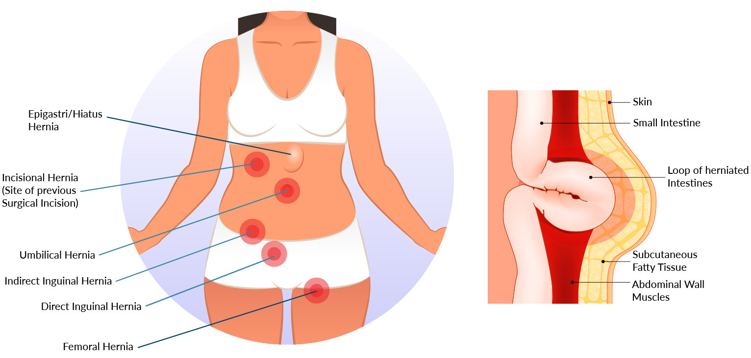 Epigastric hernia repair (adult)