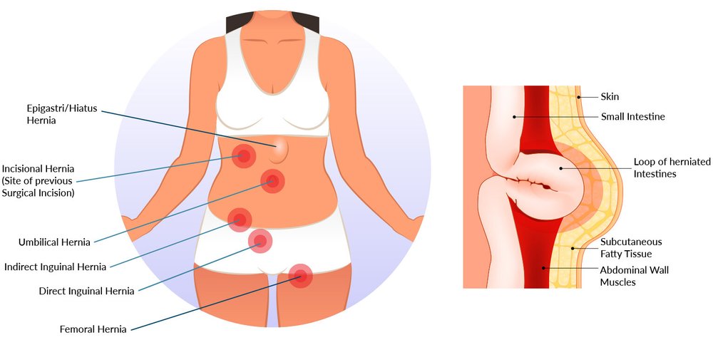 Abdominal Wall Hernia Surgery Brisbane Dr Marjan Jane Ghadiri Brisbane Bariatric Weight Loss Surgeon General Upper Gi Surgeon