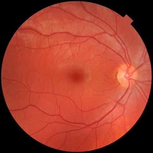 1200px-Fundus_photograph_of_normal_right_eye.jpeg