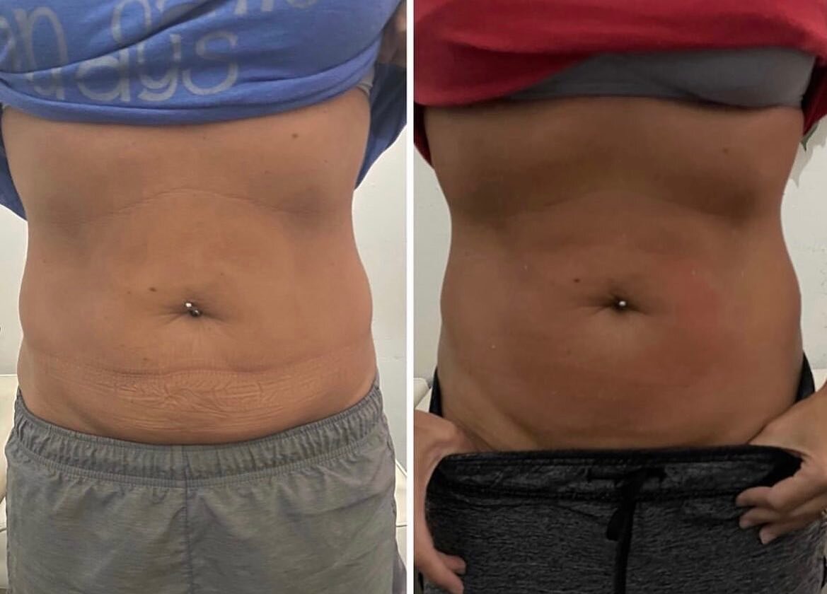 Get a kickstart to your new body with our non invasive Lipo! 👙 
$150 off any 3 or 6 session package or 3 sessions for $500 belly &amp; love handles! 
-
Procedure: Lipo Cavitation 
Sessions: 3