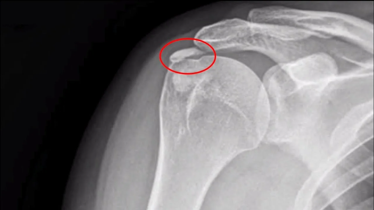 Artrosi della spalla eccentrica e concentrica