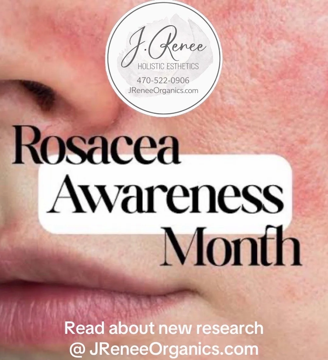 Rosacea Awareness Month