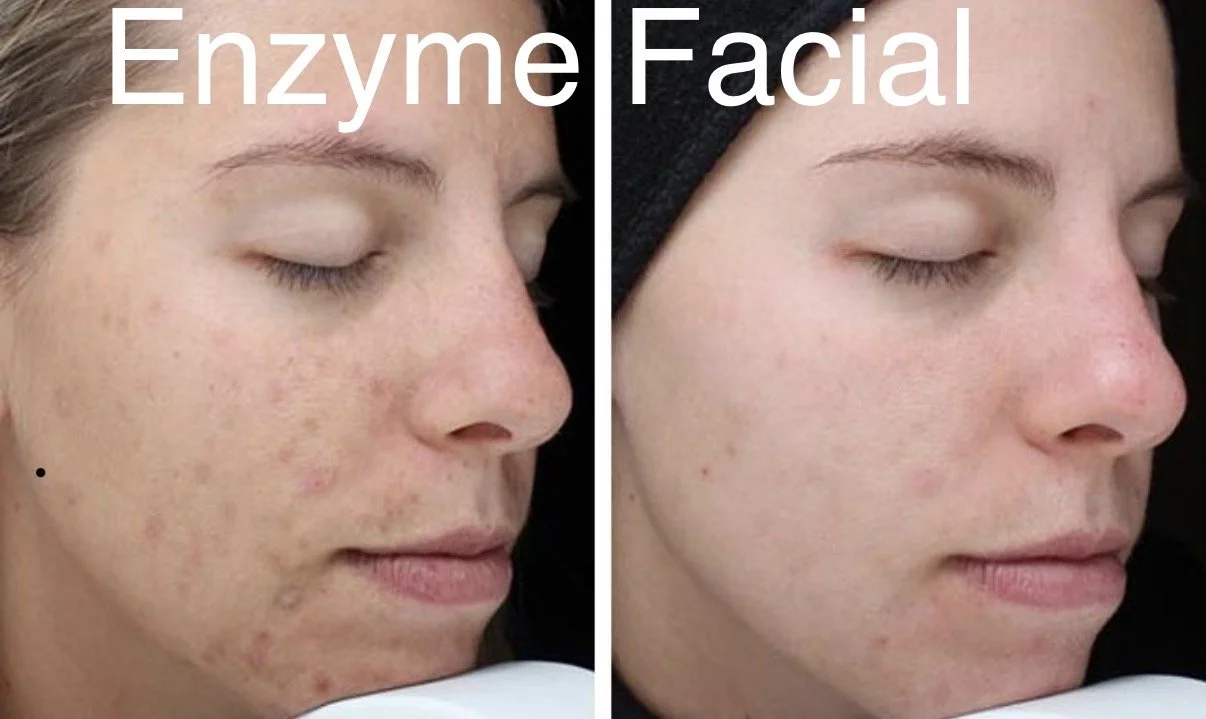 Enzyme peel facial before and after showing acne scars improved