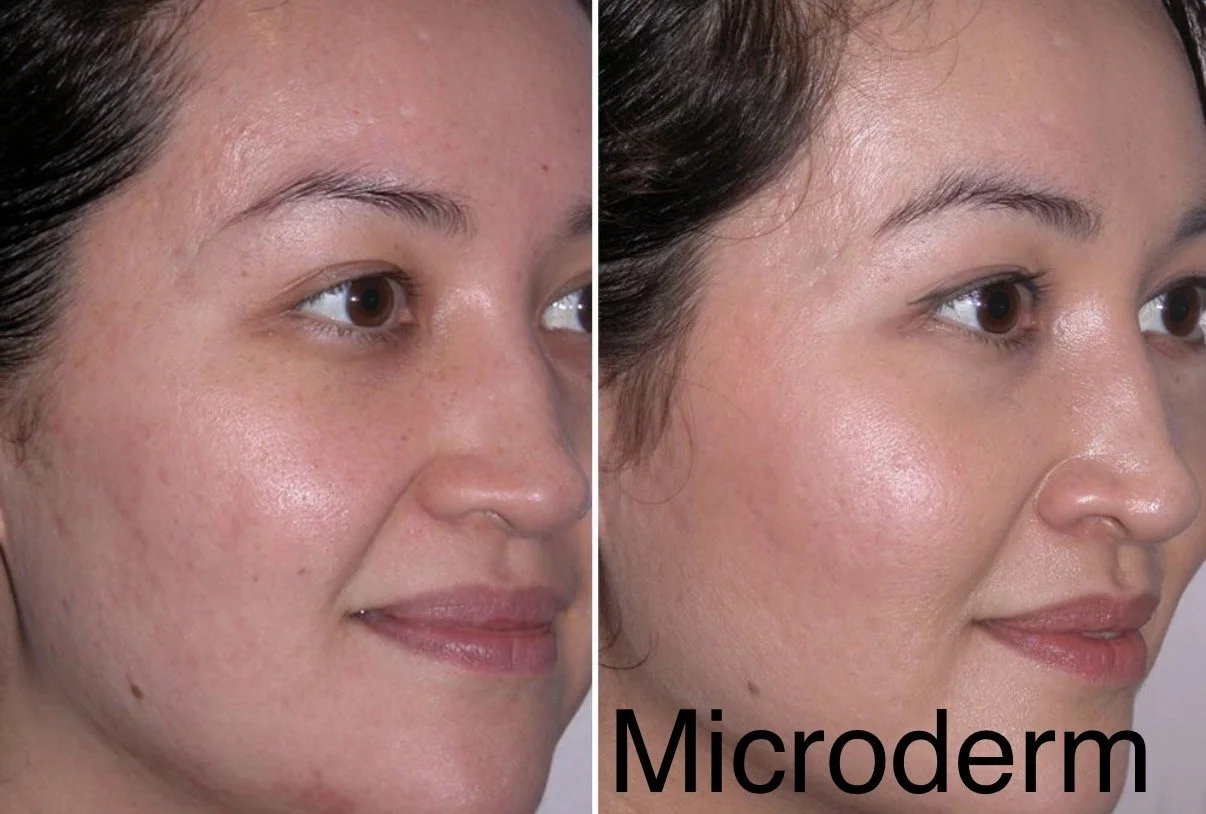 Microdermabrasion facial before and aftershowing acne scars and glow is improved in kennesaw ga