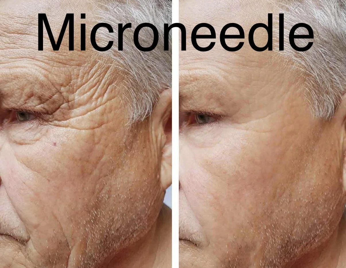 microneedling before and after for wrinkles in kennesaw