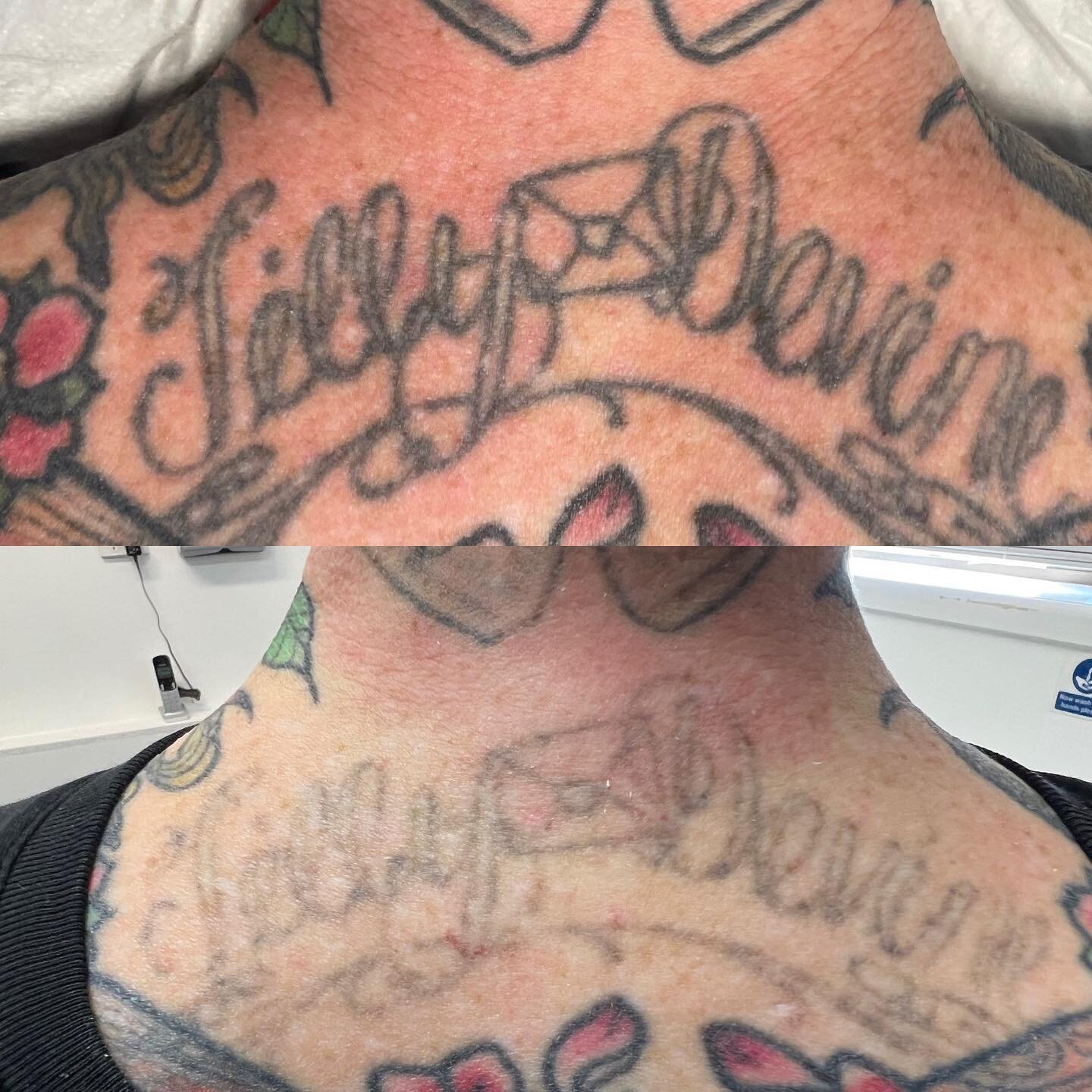 .
This tattoo required one (1) laser tattoo removal session using FracTaT technology to lighten to this effect.
.
.
.
.
⛩ @lazerandco_ 
📞 07 5493 6948
📫 hello@lazerandco.com.au
🌐 www.lazerandco.com.au
#tattooremoval  #tattoolightening #tattooremov