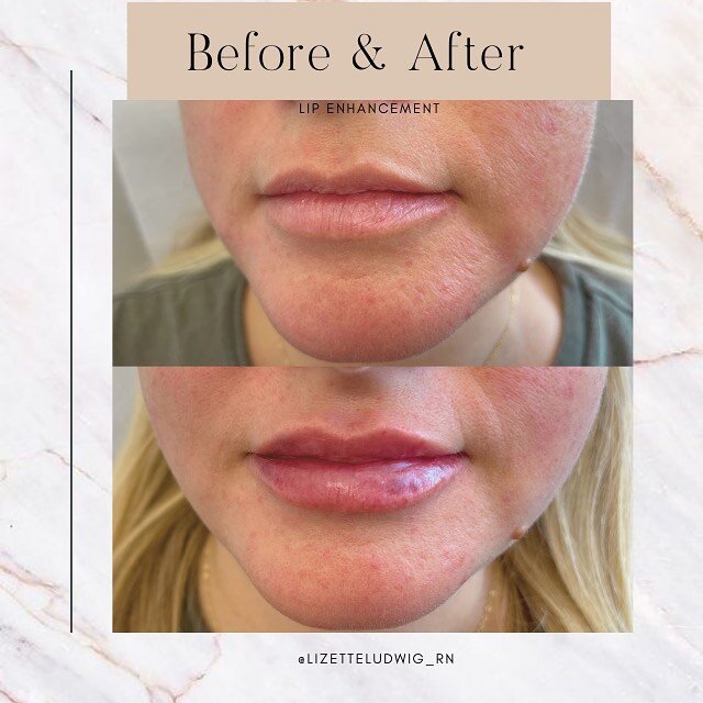 Lip Augmentation // Slowly built these beautiful lips over time, per requested by my patient she was ready for fuller lips. I&rsquo;ve injected her lips a few times over the the last couple years. We started small and built over time, gradual changes