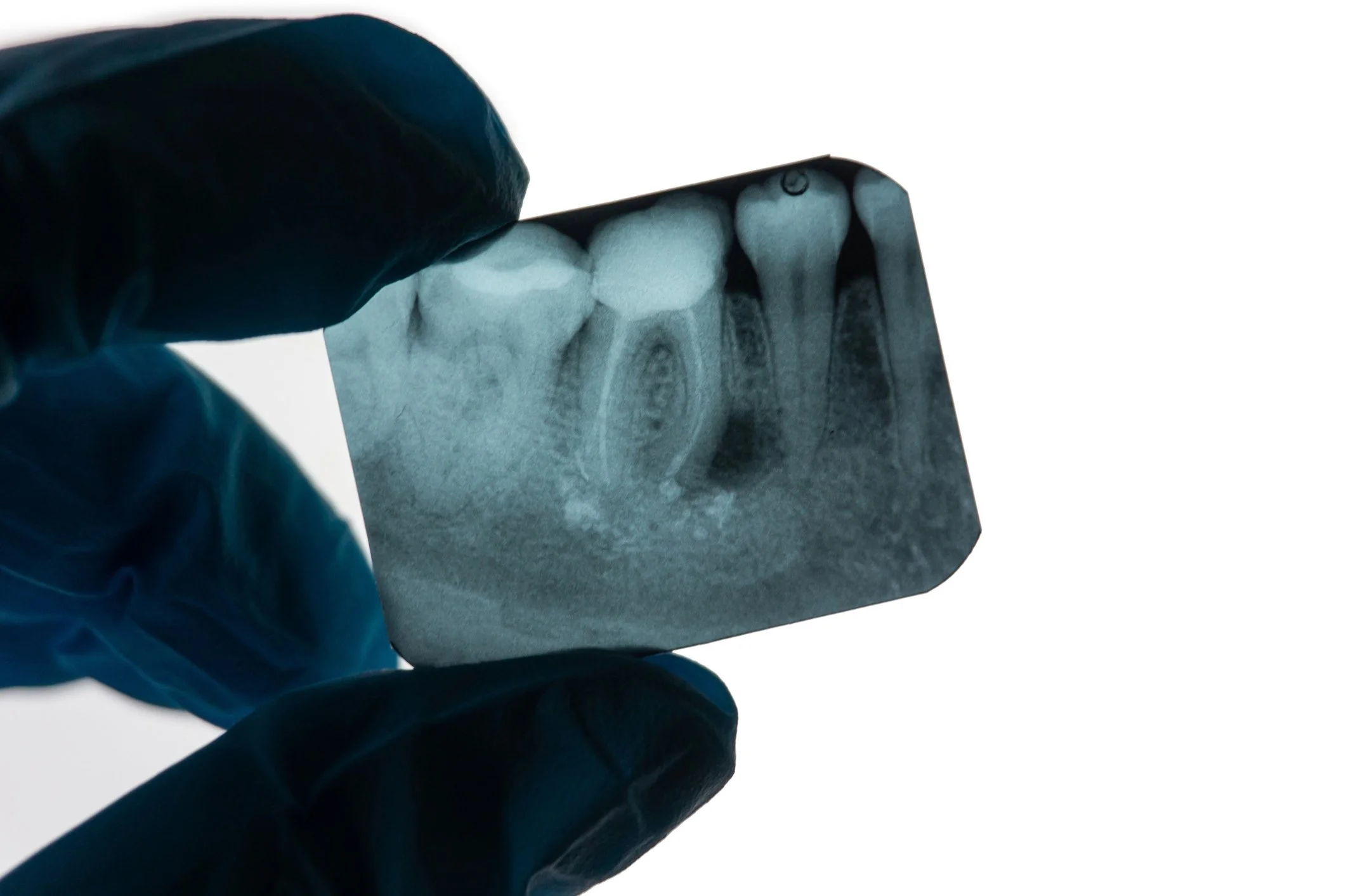 How Dental X-Rays Can Save You Money in the Long Run