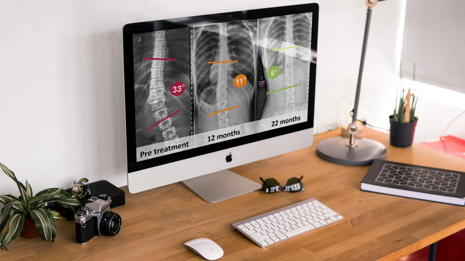 Treatment — Scoliosis Care for You