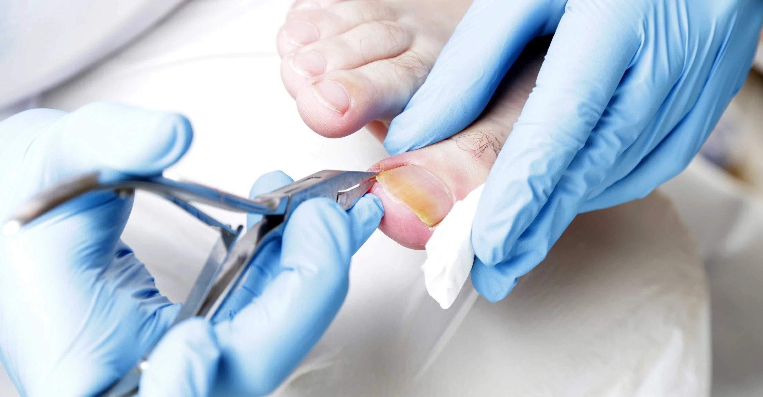 Ingrown Toenail — Woodlake Podiatry, LLC