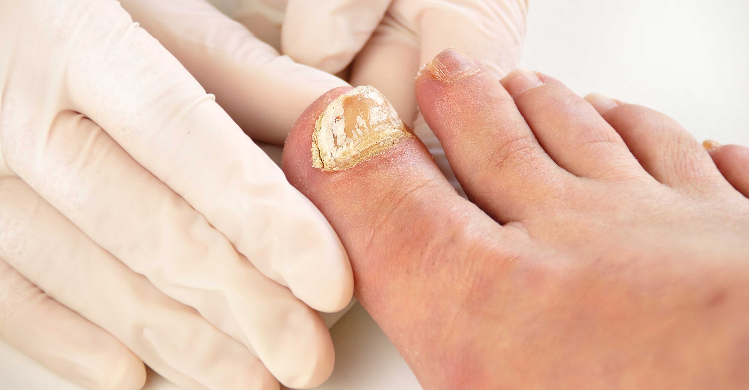 Nail Fungus Treatment in Parker, Colorado | Elevated Dermatology