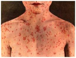 Measles - what you need to know