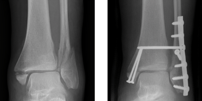 Ankle x-ray, before and after an ORF