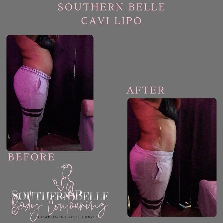 Good Morning and Happy Monday Belles! 💗 

Cavi Lipo before &amp; after, y&rsquo;all see those instant results??💁🏼&zwj;♀️ Don&rsquo;t forget to book your July appointments!! 

#cavitation #cavilipo #bodycontouring #southernbellebody #beforeandafter