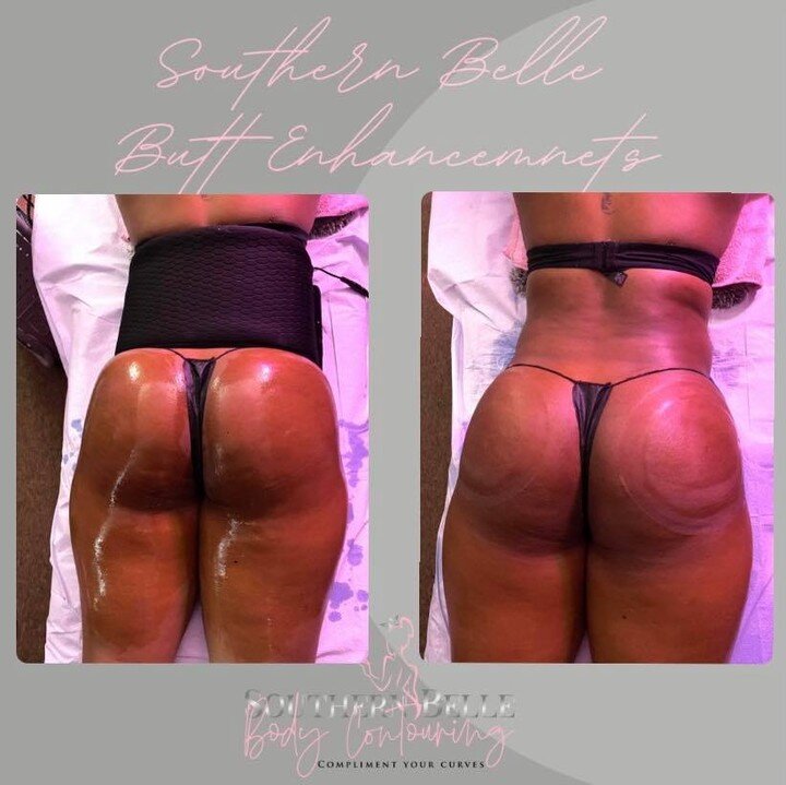 Another day, another butt enhancement down😆 

#buttenhancement #hips #juicy #bodycontouring #southernbellebody #sweetgapeach #summertimefine #bootylift