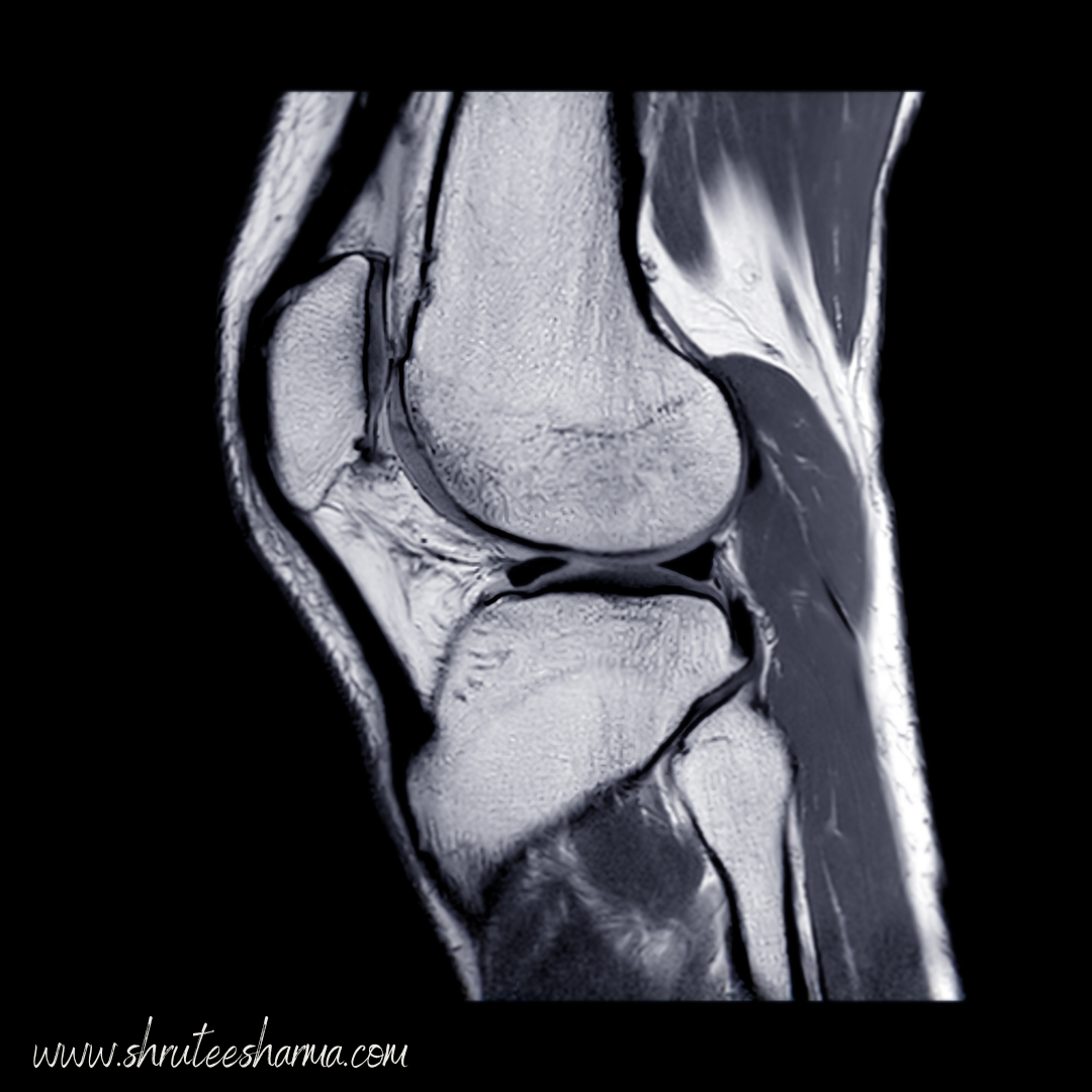 Can MRI miss the cause of knee pain?
