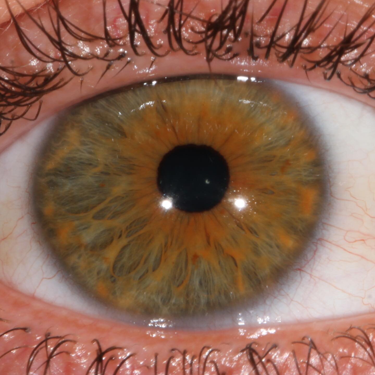 Most incredible irises this afternoon in clinic &mdash; trauma to the left iris (image 2) has caused the pupil to remain dilated.