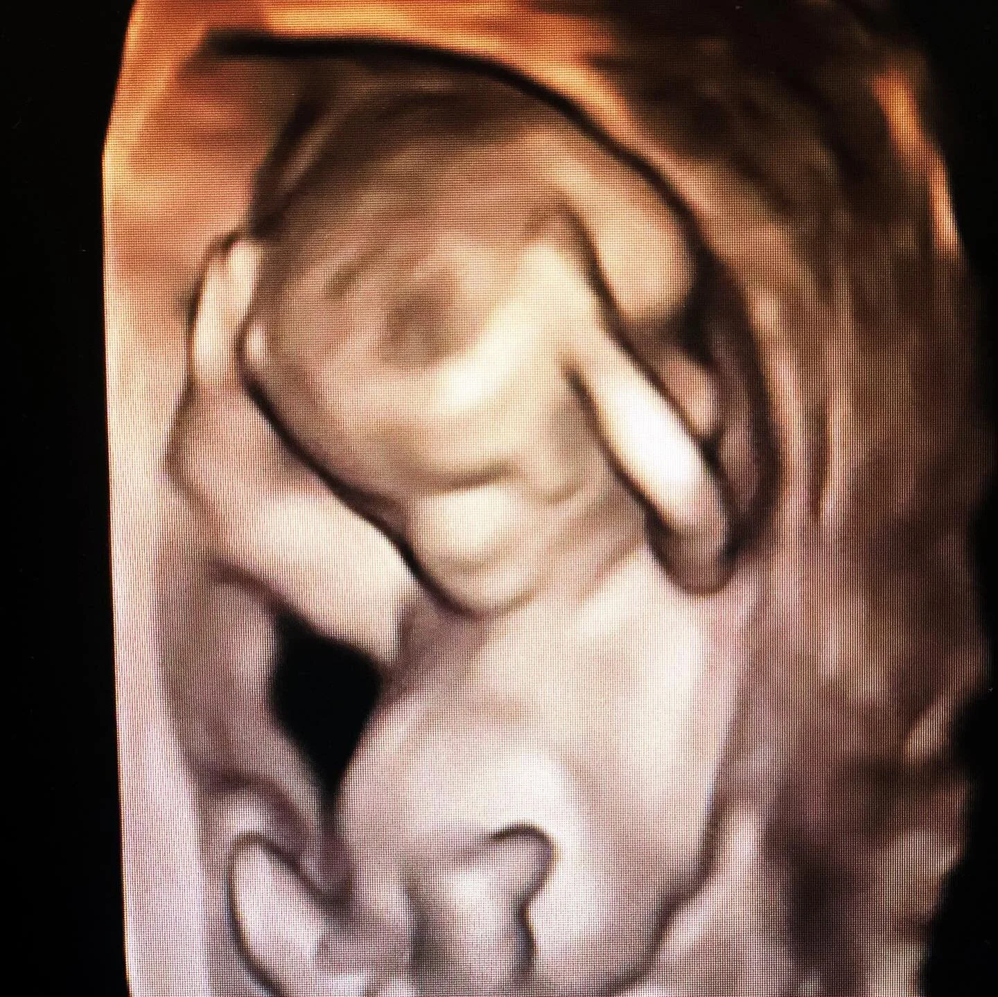 now back to our regularly scheduled programming

#WomeninMedicine
#Ilovemyjob
#Womenshealth
#SelfCare
#Anti-Racist
#MaternalFetalMedicine
#Perinatology
#ObGyn 
#PrenatalCare
#MFM
#UltraSound
#PrenatalDiagnosis
#Pandemic2020
#Covid-19
#Pregnancy
#Preg