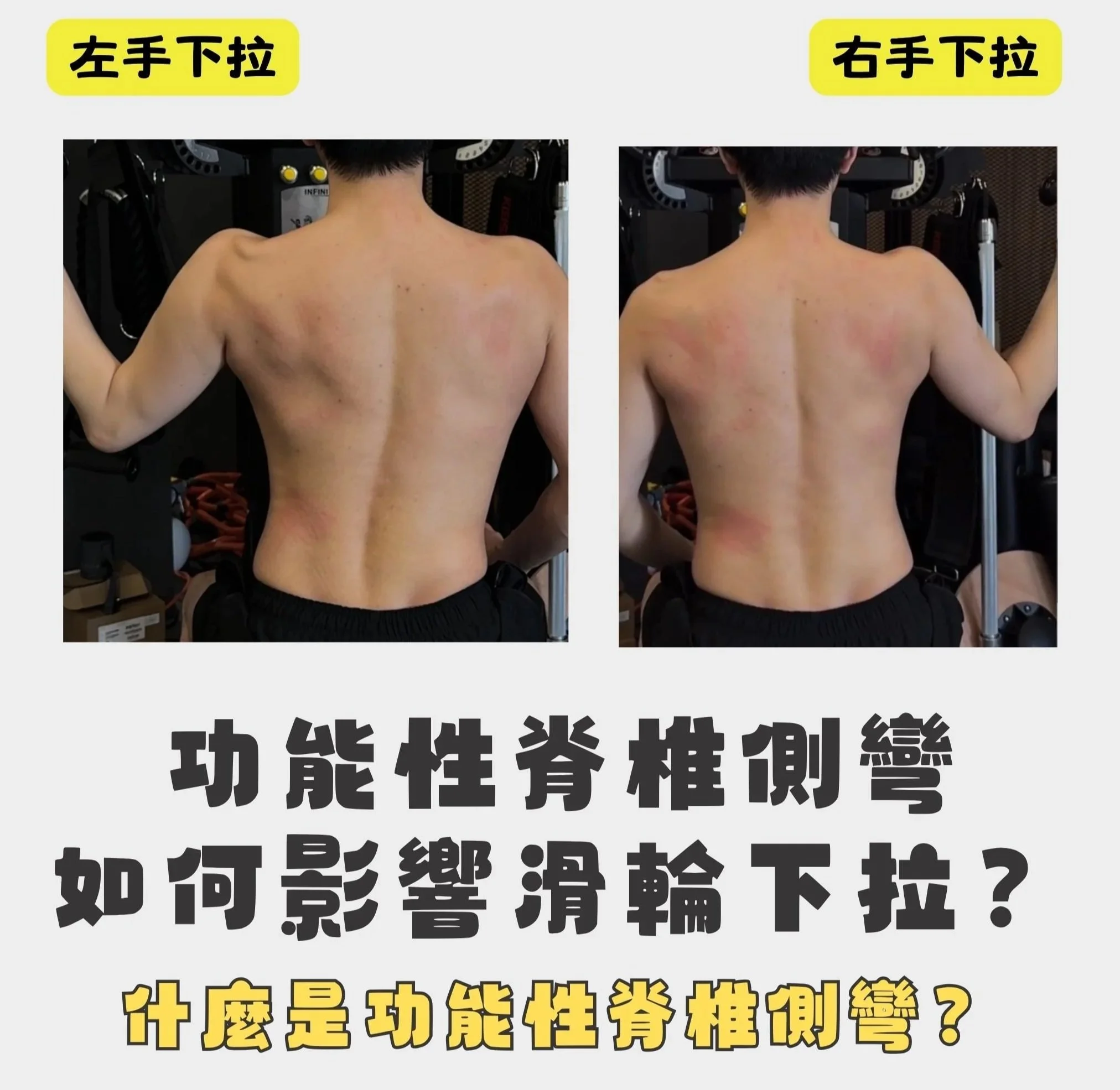 功能性脊椎側彎如何影響滑輪下拉？