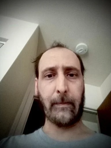 35 | James | Acute Myeloid Leukemia