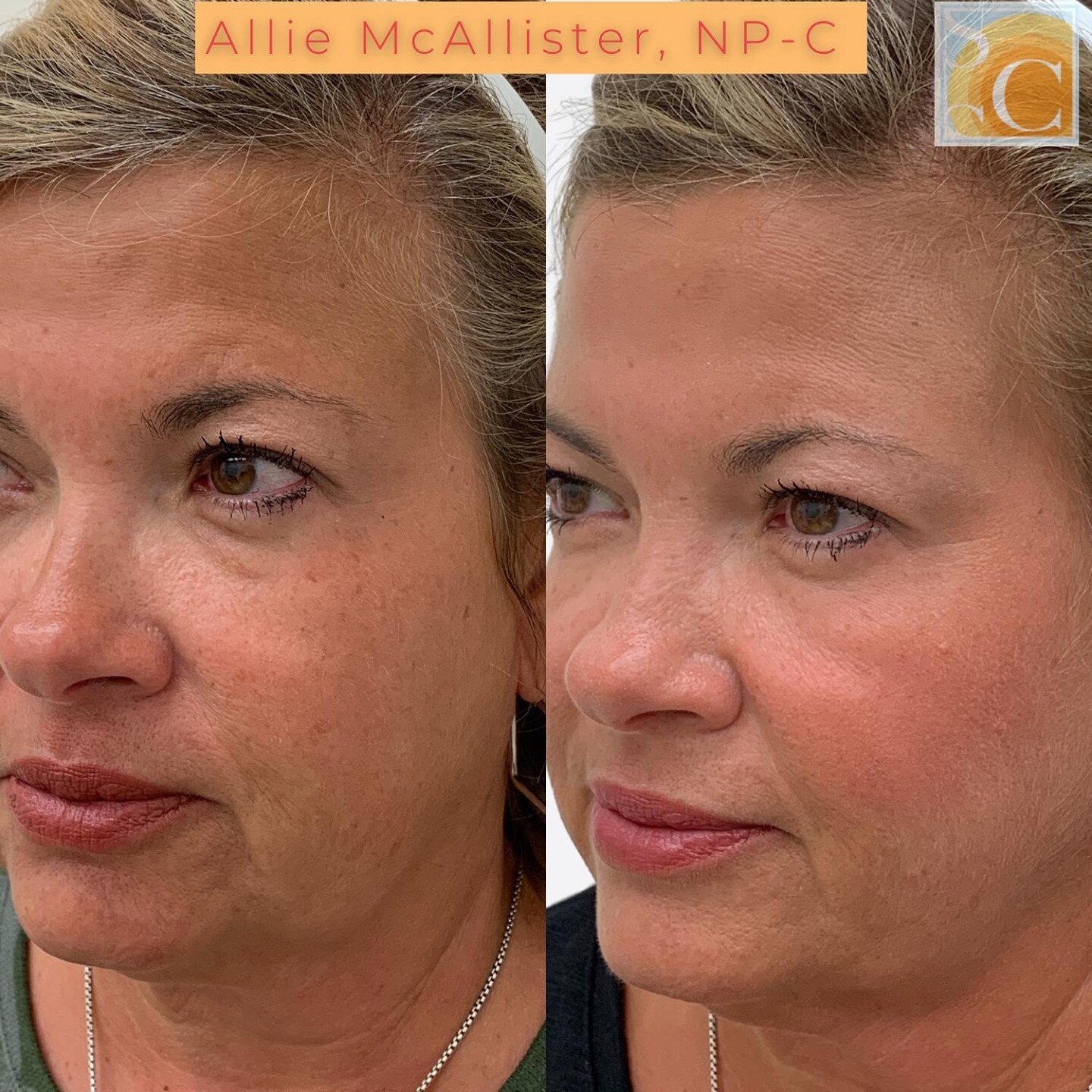 Revolumizing the mid cheek is an upgrade for the whole neighborhood! Look at the undereye improvement from mid cheek and lateral cheek correction! ⁠
⁠
⁠
⁠
💉Mid Face Filler⁠
🖐🏼 Allie McAllister, FNP-C, DCNP⁠
📞 770-422-5557⁠
💻 www.skincancerspecia