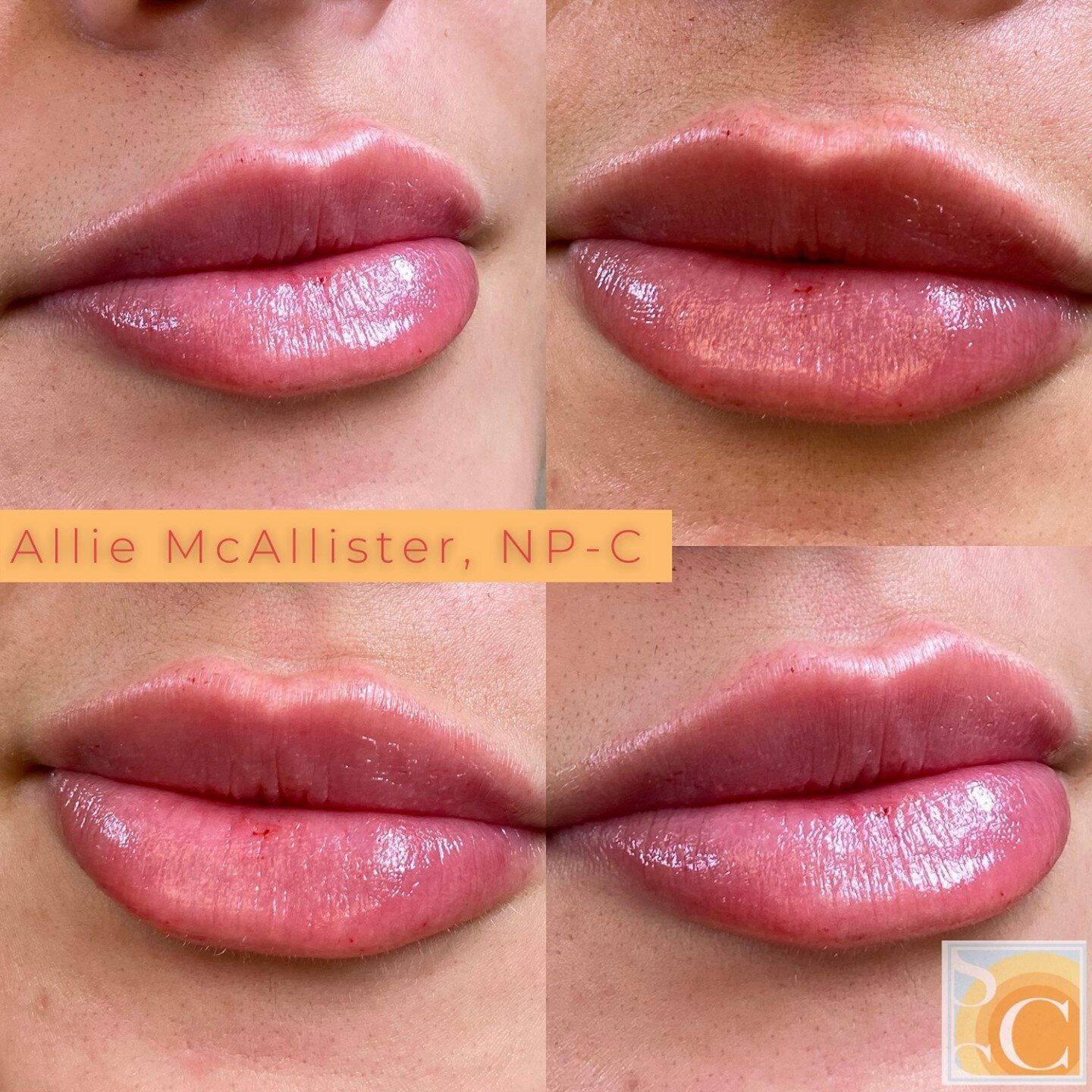 Ever had a lip crush? Because these are mine 💓⁠
⁠
⁠
⁠
⁠
⁠
⁠
⁠
⁠
💉 Lip Filler⁠
🖐🏼 Allie McAllister, FNP-C, DCNP⁠
📞 770-373-5657 ⁠
💻 www.skincancerspecialists.com⁠
⏰ Results last 8-12 mo ⁠
👩🏻&zwj;⚕️ Appointment time 40 minute visit (20 min numb