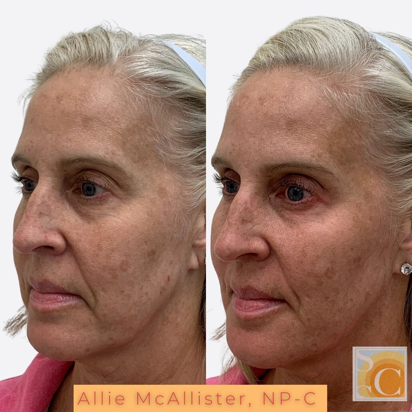 Facial Balancing for the win! Again! ⁠
⁠
Expecting 1 syringe of filler to improve global aging is like running 1 mile and expecting to lose 10 pounds. When patients trust their provider we get impactful results! ⁠This is a result with three syringes 