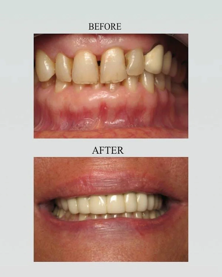This patient came to our office and was unhappy with her smile, but was only able to treat her upper teeth. Dr. Ramer gave her a beautiful smile with porcelain crown and bridges that were custom colored to blend in with the color of her natural lower