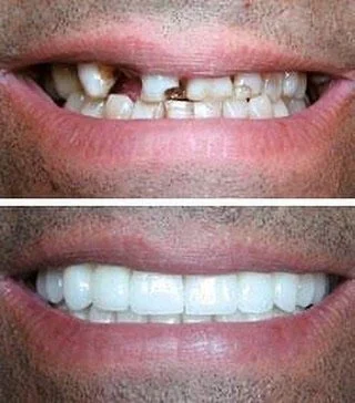 Do you have worn, decayed or broken down teeth that prohibits you from smiling? A full mouth reconstruction maybe an option for you.&nbsp;At Dr. Michael Ramer's office, not only do we strive to make you feel comfortable, it is our top priority to mak