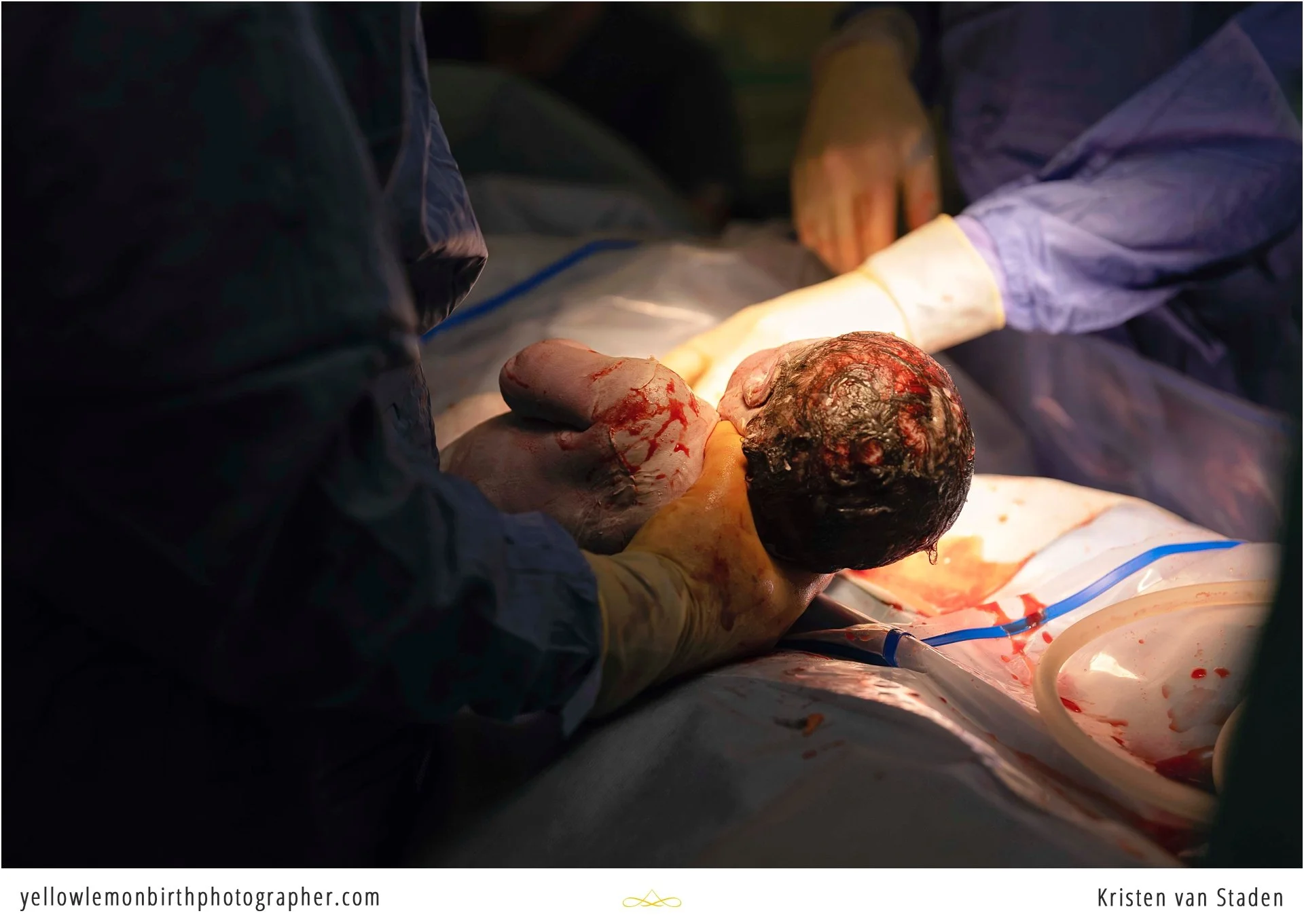 hospital c-section birth photos cape town__0006.jpg