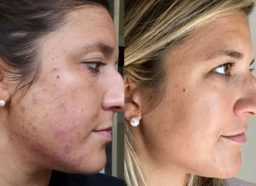 Aerolase before and after