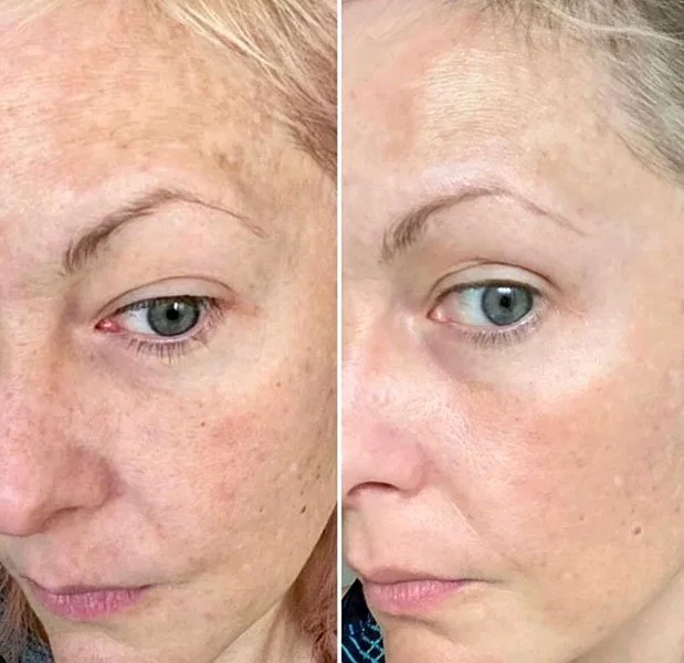 Aerolase before and after