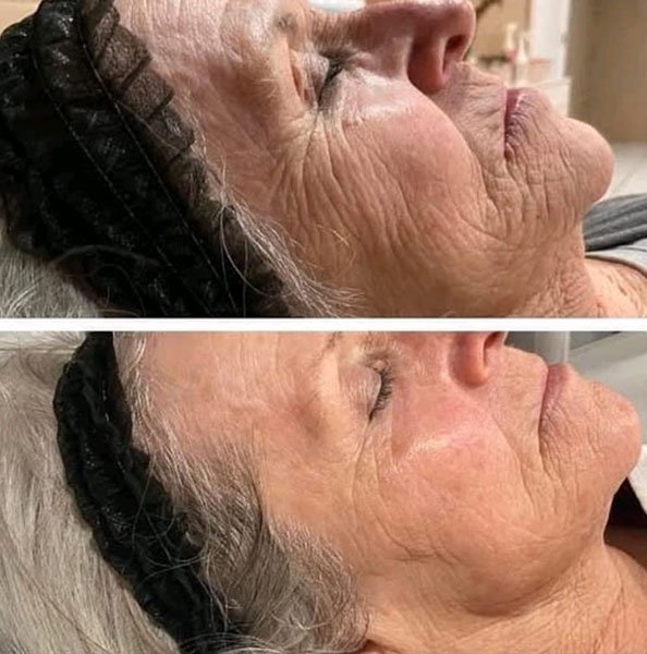 Aerolase before and after