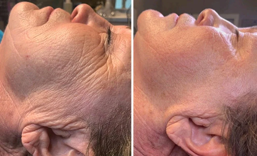 Aerolase before and after
