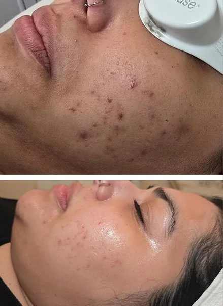 Aerolase before and after