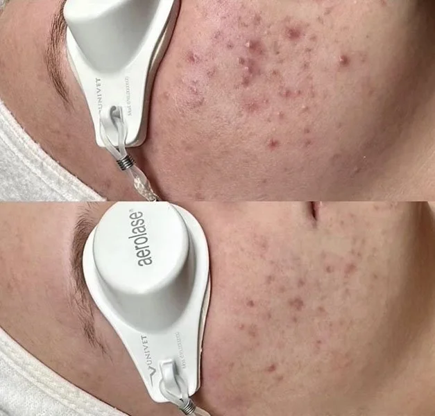 Aerolase before and after