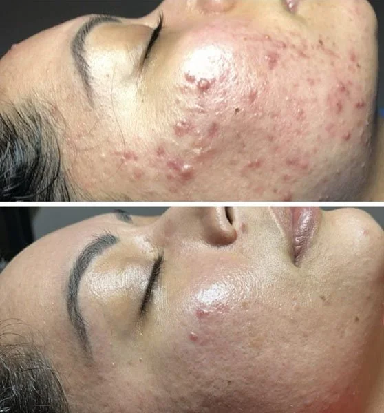 Aerolase before and after