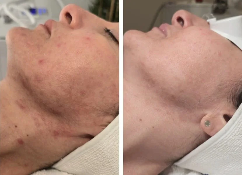 Aerolase before and after