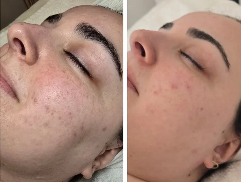 Aerolase before and after
