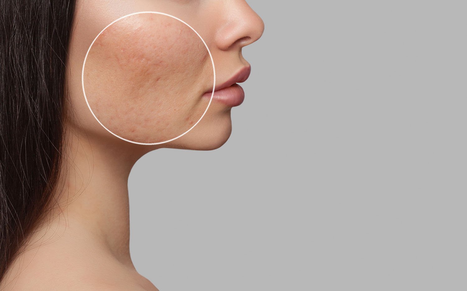 Aerolase helps all forms of acne