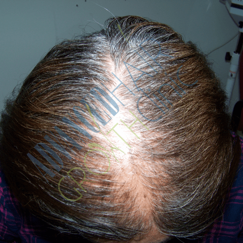 Androgenetic alopecia before treatment