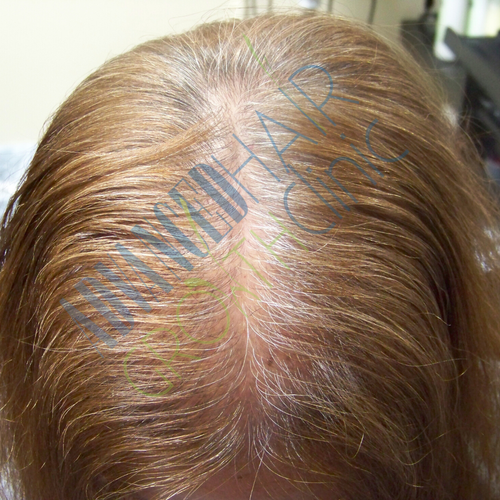 Androgenetic alopecia after 12 weeks