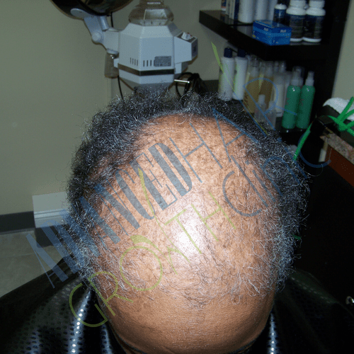 Androgenetic alopecia before treatment