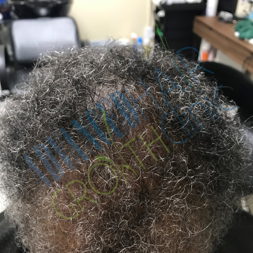 Androgenetic alopecia after 18 months