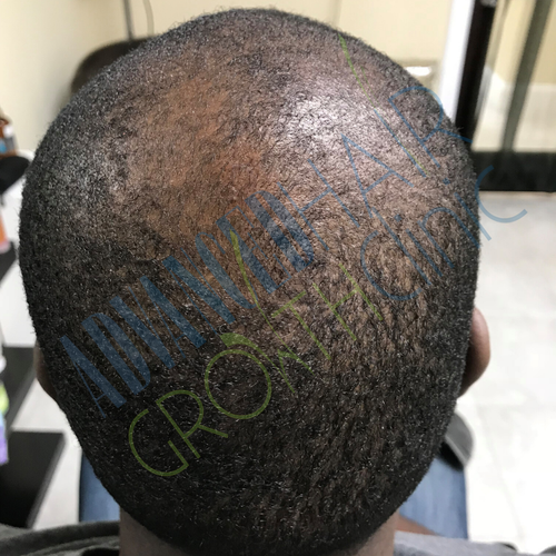 Androgenetic alopecia before treatment