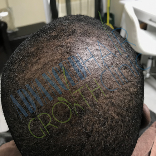 Androgenetic alopecia after 8 weeks